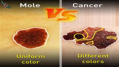 cancerous moles vs normal moles